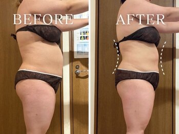 ヨサパーク サナ 二子玉川(YOSA PARK SANA)/20代/水素まみれコース/3回目