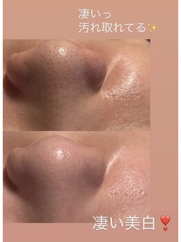 ヴィーナス(Venus)/毛穴の黒ずみ撃退!毛穴洗浄!