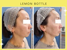 ハノハノ 八代店(HANO HANO)/小顔コルギ×レモンボトル☆