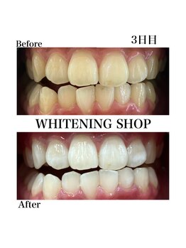 ホワイトニングショップ 豊橋店(WHITENING SHOP)/Before&After　2日目のお客様
