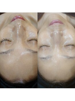 ボーソリューション(Beau-Solution)/【40代　一度の施術で透明感】