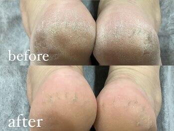 アルゴ 熊本光の森店(ALGO)/【かかと】スクラブでツルスベ肌