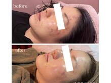 ワイズサロン(Y's salon)の雰囲気（IPL光フォトは高周波搭載！肌奥までアプローチで従来の5倍の効果）