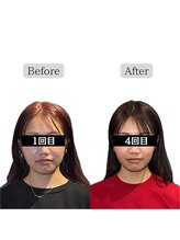 クリアランス(CLEARANCE)/施術回数4回 担当者TAIGA