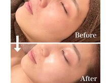 ポードジェーン(peau de jeune)/REVIハーブピーリング