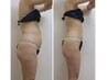 【人気No.1】全身の脂肪まるごと撃退！痩身マシンW使い¥33000→¥15000
