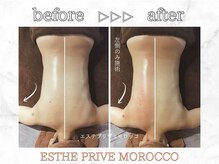 エステプリヴェモロッコ(ESTHE PRIVE MOROCCO)/カッサ+スライドカッピング