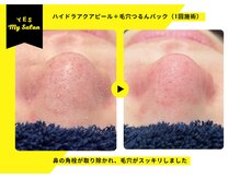 イエス マイサロン(yes My Salon)/ハイドラアクアピール症例
