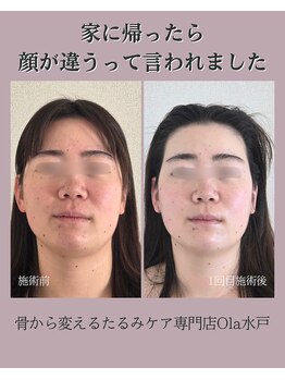 オラ(Ola)/30代/顔のむくみ悩み・小顔