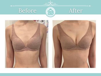 美人バスト 辻堂店/バストアップ★☆症例写真☆★