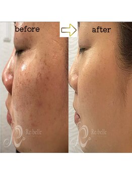 キレピア 新市街店(kirepia)/リベルハーブピーリング