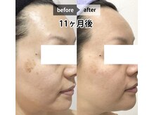 グランピピ(Grand PiPi)/肌「シミ」改善