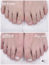 ティアラネイル 宇都宮/リプロネイル深爪矯正コース