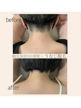 リアリ(Riali)/うなじ脱毛