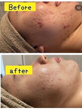 インチャント(enchant)/ニキビケア