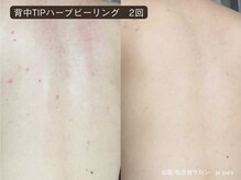 ジュパール(je pars)/背中TIPハーブピーリング