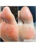 【当日予約も大歓迎】フットの角質ケアでツルツルなお足元に★