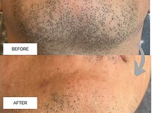 リンネ(Rin'ne)/[メンズ髭脱毛] 青ひげなくなる!