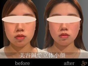 チョコバリ 渋谷店(chocobari)/小顔×リフトアップ(美容鍼)20代