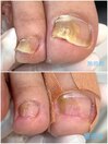 長年抱えていた爪のトラブル