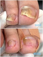 レフス 北参道店(REFUSS)/長年抱えていた爪のトラブル