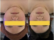 【徹底解剖】最新の脂肪ケア「レモンボトル」×「熟練手技」で理想のラインを作る極上工程