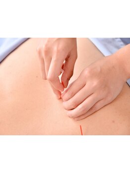 鍼灸施術を受けたい