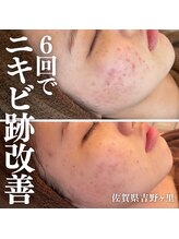 カンフリエ 吉野ヶ里店(Camphrier) ピーリング 毛穴相性◎