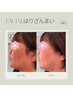 新メニュー【20名限定コース】夏の紫外線＆たるみケア♪ハリ艶リフトアップ