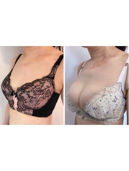 バストラインを整えたい