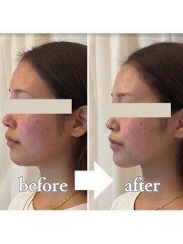 ブプラ 沖縄那覇店(BUPURA)/頭蓋骨小顔矯正