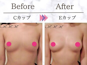 メディカルサロン エム エム エム 大阪梅田グランドサロン(M.M.M)/【バストアップ例】　C→Eカップ