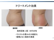 トラレス(Trouless)/脂肪冷却