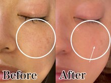 いやしの家さくら/シミケア打ち放題ビフォーアフタ