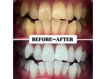 ホワイトニングサロン 豊中/Before&After美白ホワイトニング