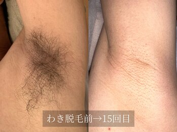 アルム(Arum)/メンズわき脱毛