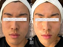 フレキシ 表参道(Flexi)/小顔矯正＋ハーブピーリング