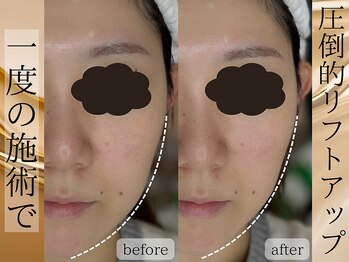 ライリー(Rairy)/最強肌質改善プラズマカリファEX