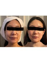 ウィッシュプロサロンケー(WISHpro salon K)/両顎骨切りインディバ術後ケア