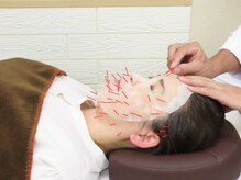 石野鍼灸院の雰囲気（静岡では珍しい幹細胞美容鍼で根本から改善します。）