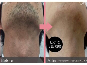 リアリ(Riali)/ヒゲ脱毛