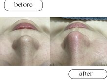 ルボン(RUBON)/鼻Wax＋ピーリング＋毛穴洗浄