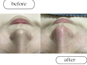 ルボン(RUBON)/鼻Wax＋ピーリング＋毛穴洗浄