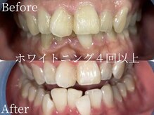 ミスティア(mistia)/セルフホワイトニング 4回以上