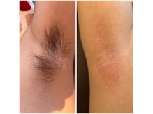 シュガーリングアイムミー(sugaring I'mme)の雰囲気（その場でヘアーがなくなる★チクチク感なしのナチュラル脱毛）