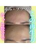【韓国鎮静管理】秋の肌管理に♪CICA鎮静エピダームシェービング
