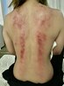 【オプションメニュー】肩と背中のデトックスかっさ 10分程度