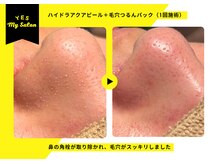 イエス マイサロン(yes My Salon)/ハイドラアクアピール症例