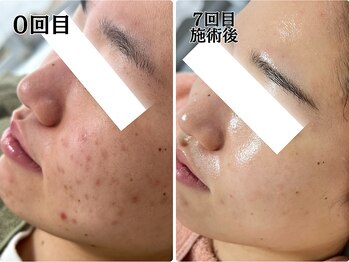 ゆらり/ニキビ・くすみ・毛穴ケア