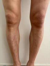 ブルーココア(BlueCocoa)/メンズ脚。4ヶ月後